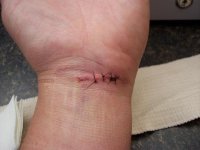 wrist injury.JPG